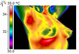 Thermography Breast Scan Carcinoma Confirmed 2