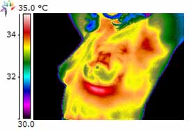 Thermography Breast Scan Carcinoma Confirmed 3