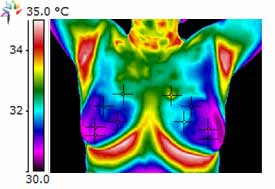 Thermography Breast Scan I3C Supplementation After