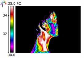 Thermography image Gingival Inflammation