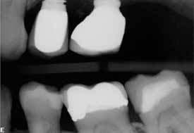 NecroticMolar-Right-XRay