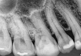 NecroticTooth XRay Upper