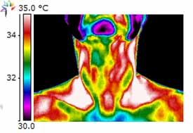 Thermography Carotid Occlusal Disease