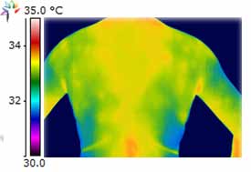 Thermography Fibromyalgia Image