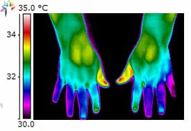 Carpal Tunnel Syndrome Top of hands