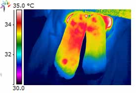 Thermography Plantar Fasciitis image